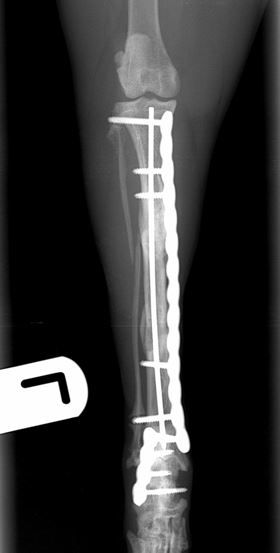 radiographic union of both fractures